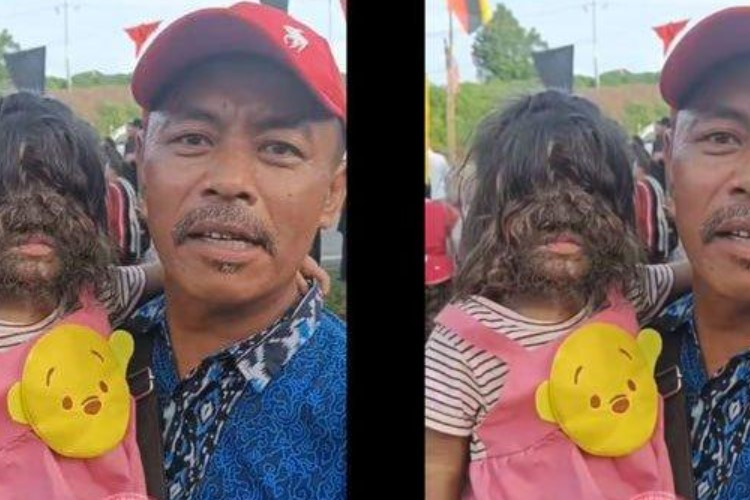 Mengenal Missclyen yang Menderita Sindrom Manusia Serigala, Penyakit Langka Buat Wajah Penderitanya Lebat Ditumbuhi Rambut  